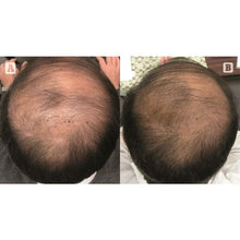 Load image into Gallery viewer, PRP Hair Restoration