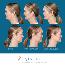 Load image into Gallery viewer, Kybella® Neck Firming Package