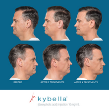 Load image into Gallery viewer, Kybella® Neck Firming Package