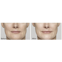 Load image into Gallery viewer, Restylane® Lyft