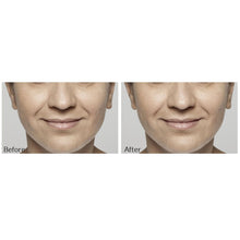 Load image into Gallery viewer, Restylane® Lyft