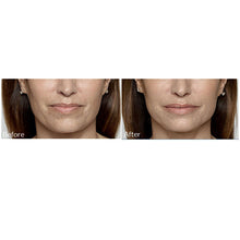 Load image into Gallery viewer, Restylane®