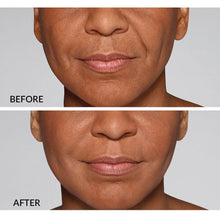 Load image into Gallery viewer, Restylane® Refyne