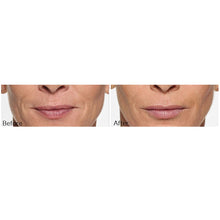 Load image into Gallery viewer, Restylane®Silk and Lines