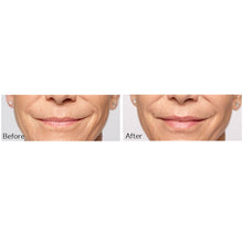 Load image into Gallery viewer, Restylane®Silk and Lines