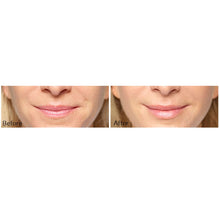 Load image into Gallery viewer, Restylane®Silk and Lines