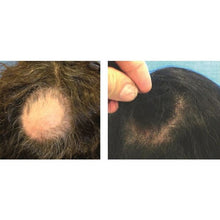 Load image into Gallery viewer, PRP Hair Restoration
