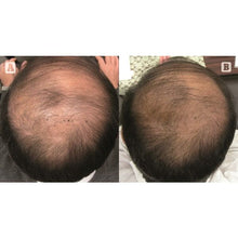 Load image into Gallery viewer, PRP Hair Restoration
