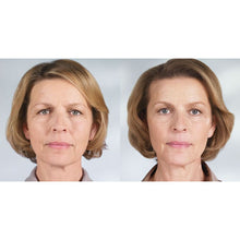 Load image into Gallery viewer, Sculptra® Aesthetic
