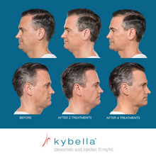 Load image into Gallery viewer, Kybella® Neck Firming Package
