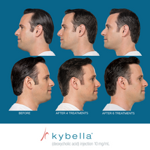 Load image into Gallery viewer, Kybella® Neck Firming Package
