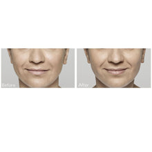 Load image into Gallery viewer, Restylane®
