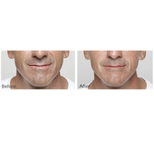 Load image into Gallery viewer, Restylane®
