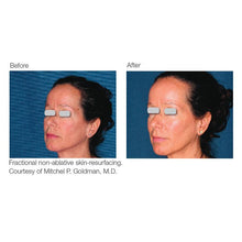 Load image into Gallery viewer, ResurFX™ Laser-Single Treatment

