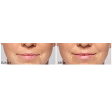 Load image into Gallery viewer, Restylane®Silk and Lines

