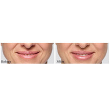 Load image into Gallery viewer, Restylane®Silk and Lines
